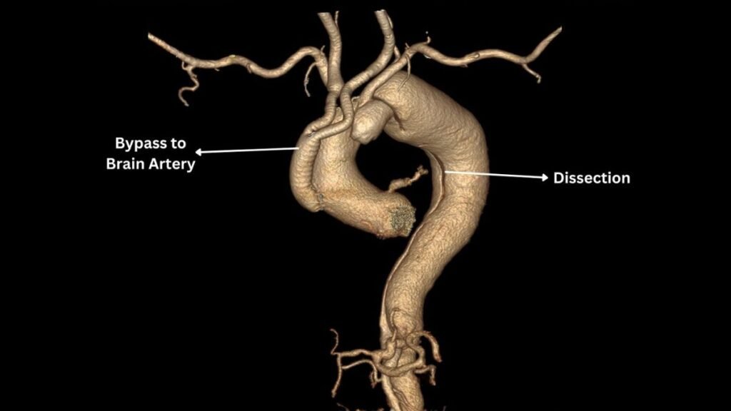 Medical Marvel at SSB Heart and Multispeciality Hospital: Pioneering Hybrid Procedure Saves a Life - PNN Digital